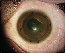 Figure 2. Poor edge design mimics shadowing effect of edge lift when viewed with biomicroscopy in a patient who has unspecified lens awareness.