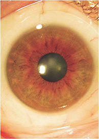 Figure 1. A 16mm scleral lens with a customized toric landing zone.