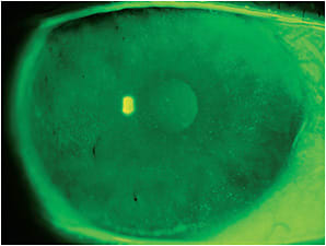 Figure 6. Solution-induced corneal staining.