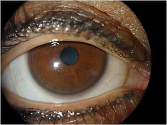 Figure 3. Front view of patient&#x2019;s scleral lens OD.