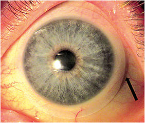 Figure 3. A scleral lens with a spherical landing zone that exhibits edge lift secondary to scleral toricity.