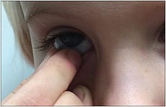 Figure 2. Children as young as 4 years old can start learning how to handle contact lenses.