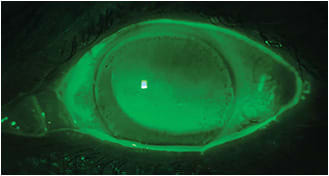 Figure 11. Corneal edema after accidentally wearing a scleral lens overnight. Note the furrow staining in the periphery and epithelial blebs and microcysts scattered throughout the cornea.&#xD;&#xA;Image courtesy of Karen G. Carrasquillo, OD, PhD