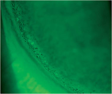 Figure 12. Peripheral corneal staining as epithelial bullae secondary to a lens that is riding firmly on the peripheral cornea.