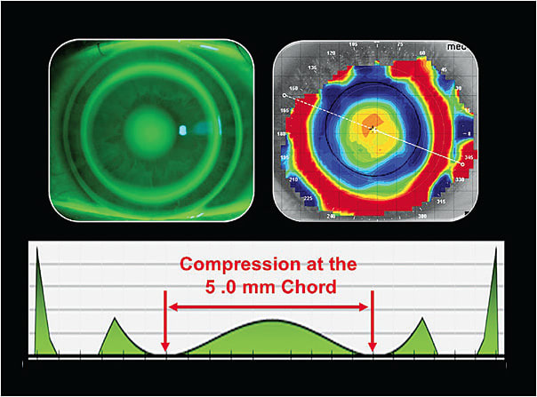 Figure 1. The tangential map of a corneal topographer best shows the ring of epithelial compression at a chord of 5.0mm for hyperopic ortho-k.