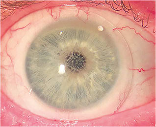 Figure 10. The dispensed 16mm scleral lenses had landing zones that aligned with bulbar/conjunctival scleral surface with an adequate fluid reservoir.