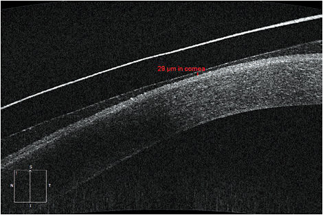 Figure 1. A presumed area of lens touch is clearing the cornea by 29 microns when viewed with AS-OCT.