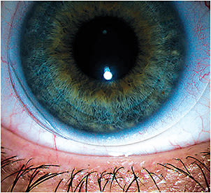 Figure 1. Unacceptable fit of a SiHy lens on a regular cornea.&#xD;&#xA;Courtesy of Amy Dinardo, OD, MBA