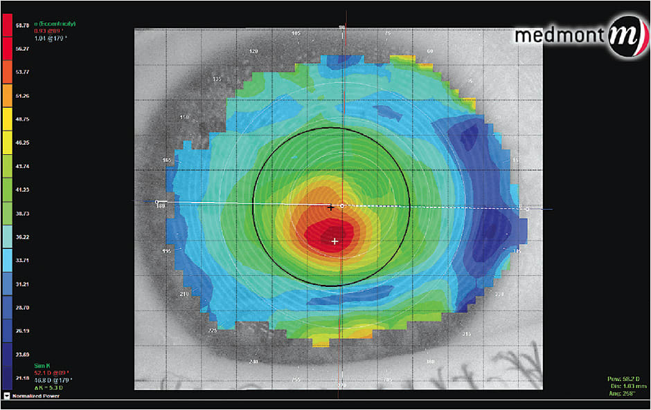 Figure 5. Tangential map showing the cone apex (red area) in a patient who has keratoconus.