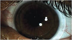 Figure 2. A hybrid lens on an eye with low corneal cyl at the end of one week of full-time lens wear. This lens exhibited temporal decentration but excellent visual endpoints and movement.