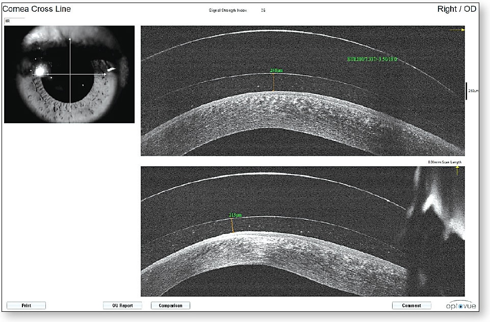 Figure 8. AS-OCT cross line scan of a keratoconic eye with a scleral lens. Courtesy of Jeff Sonsino, OD