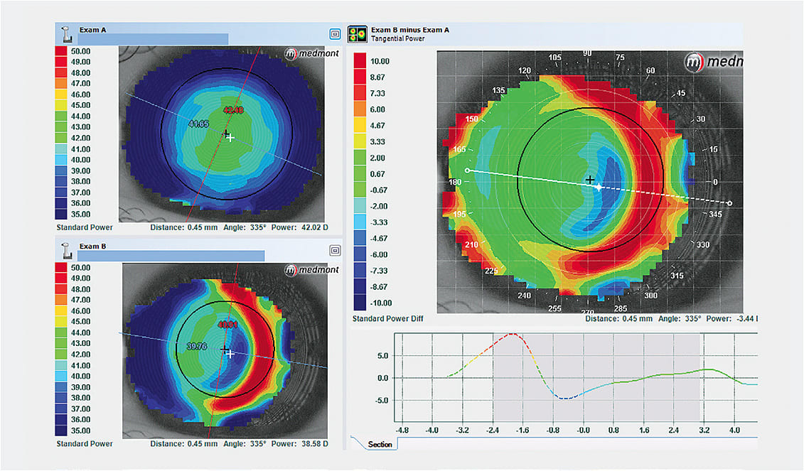 Figure 5. A topographic red ring that decenters nasally or temporally with respect to the pupil indicates lateral displacement of an orthokeratology lens.