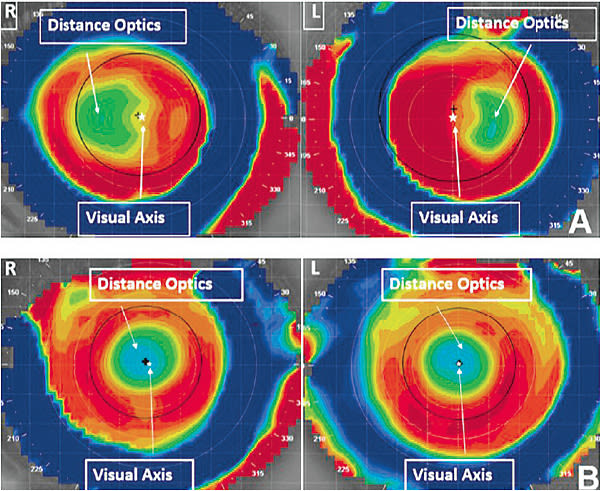 Figure 2. Tangential corneal topography of (top) the geometrically centered optic design and (bottom) the 1.0mm nasally offset design.