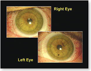 Figure 1. The patient wearing his scleral lenses.