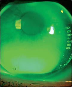 Figure 1. A low-riding front-surface-toric corneal lens.