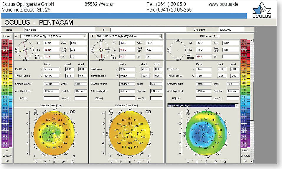 Figure 11. Use of corneal topography for assessment of treatment effect in corneal reshaping (pre-treatment subtracted from post-treatment). In this case, it shows a well-positioned, sized, and shaped treatment.