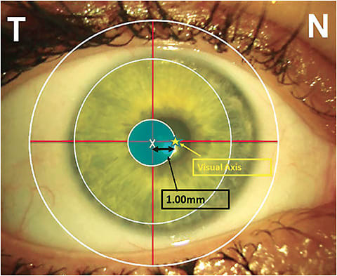 Figure 1. The nasal line of sight in relation to the position of a geometrically centered soft multifocal lens design.