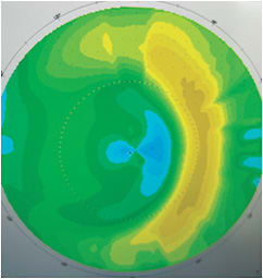 Figure 1. Axial map depicting a laterally decentered treatment zone. The patient reported reduced visual acuity, which did not improve with a refraction. The lens appeared centered, and the refraction over the lens was +0.25D. Appropriate changes were made to improve the fit, and thus visual acuity, but only with the help of this map.