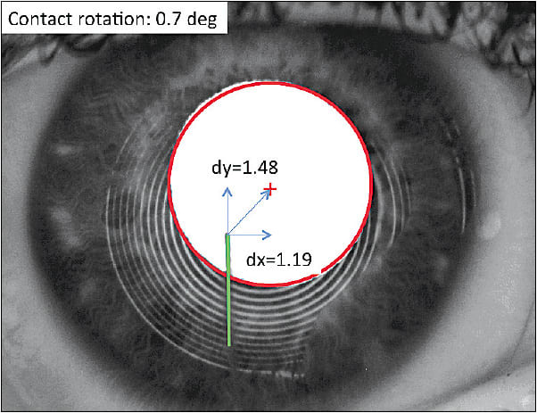 Figure 1. Decentered scleral lens on the right eye of a keratoconus patient.