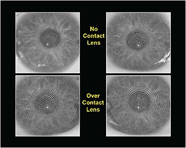 Figure 3. (Top) A keratoconus patient who has irregular astigmatism as verified by distorted mires with videokeratoscopy. (Bottom) Videokeratoscopy over a thickened custom soft lens for keratoconus showing more regular mires on the same patient.