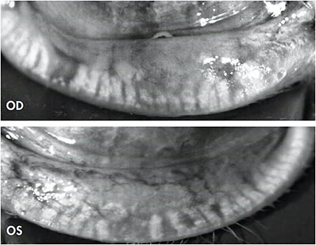 Figure 2. Meibomian gland dropout in the patient in Case 1.