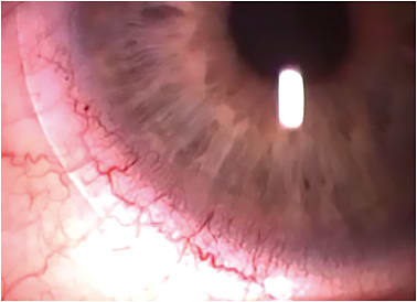 Figure 4. Limbal redness associated with hydrogel soft lens wear.