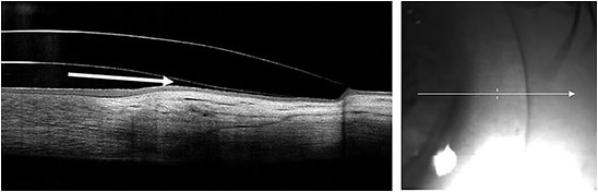 Figure 1. The cross-section of the scleral lens in the landing zone shows a steeper profile than desired. This indicates that a significant region below the landing zone is elevated and ultimately impinging at the most distal portion of the landing zone.