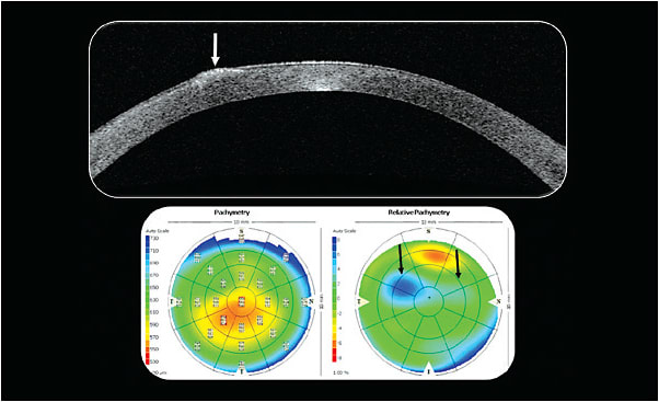 Figure 3. Optical coherence tomography imaging of the right eye. Note the relative pachymetry map on the right side highlighting the two primary areas of localized corneal thickening.