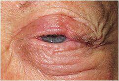 Figure 1. After removal of her tarsorrhaphy OS, the patient had lagophthalmos with forceful lid closure.