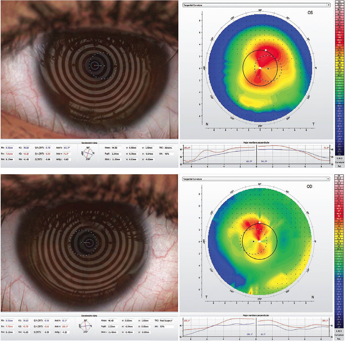 Figure 1. Corneal topographies of Case 1 patient demonstrating a small cornea with flat K readings.