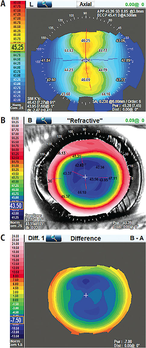 Figure 1. Toric orthokeratology lens design on an eye with a spectacle Rx of –7.50 –2.50 x 180.Images courtesy of Brett O’Connor, OD