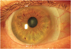 Figure 3. Customized 16mm scleral lens with landing zone alignment.