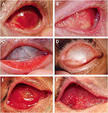 Figure 4. Common socket presentations. 1) Enucleation with implant: Removal of the globe with subsequent implant placement within the muscular cone&#x2014;(A) superficial redness of the conjunctiva with a well-centered implant; (B) shows an overall blanched appearance to the socket tissues with very little conjunctival irregularity. 2) Evisceration with implant: contents of the socket are removed and an implant is placed within the remaining globe structures&#x2014;Overall, these sockets are easier to judge for disorders due to the similarities of scleral disorders. (C) no corneal tissue remains, no sutures present; (D) corneal tissue opacified with increased vascularization from the sclera to the corneal tissue. Note: A-D are considered to be normal socket presentations. 3) Extruding implant: thinned socket tissues and sharp impact edges may eviscerate the overlying tissue and result in expulsion of the implant. (E) shows an implant in the process of extruding. (F) shows the results of socket reconstruction surgery with a tissue graft.