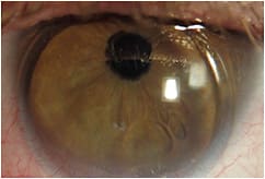 Figure 2. High-plus corneal GP lens that is inferiorly decentered and binding to the patient’s cornea.