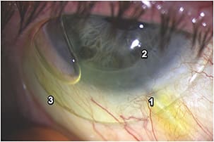 Figure 1. (1) NaFl conjunctival staining over a surface elevation due to an underlying tube shunt, despite an isolated micro scleral lens vault over this area; (2) graft-host junction with buried suture; and (3) bubble introduced due to misalignment of the scleral haptic at 7 o’clock, with NaFl seepage evident.