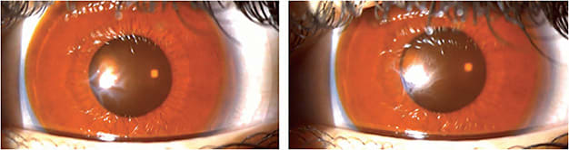 Figure 3. A light amber tint was added to these custom lenses to improve contrast sensitivity during a professional sport. The diameter was also increased to accommodate larger-than-normal HVIDs.