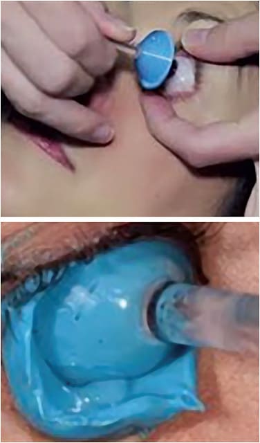 Figure 6. Obtaining impressions of the ocular surface. Images courtesy of Cheri Nau, OD