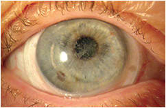 Figure 3. Recurrence of granular dystrophy post-penetrating keratoplasty. This patient is successfully wearing a scleral lens.