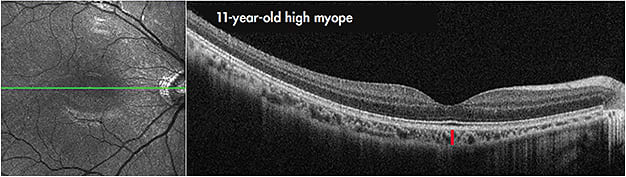 Figure 4. Example of a foveal-centred OCT scan from an 11-year-old, highly myopic male (spherical equivalent refraction &#x2013;7.00D, axial length 26.86mm). Note the substantial thinning of the choroid evident in this patient (mean subfoveal choroidal thickness of 117&#xB5;m). The red line illustrates subfoveal choroidal thickness.