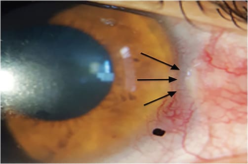 Figure 2. Friction and hyperemia generated in the pinguecula due to the notched lens that was rearranged. Image courtesy of Omar Sámano.