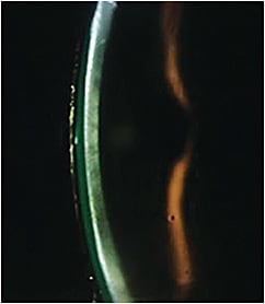 Figure 4. Corneal haze can be seen behind the tear lens reservoir in a patient who has Fuchs’ dystrophy.