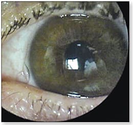 Figure 4. Flat skirt curve illustrated by edge pucker in a hybrid lens for normal corneas.