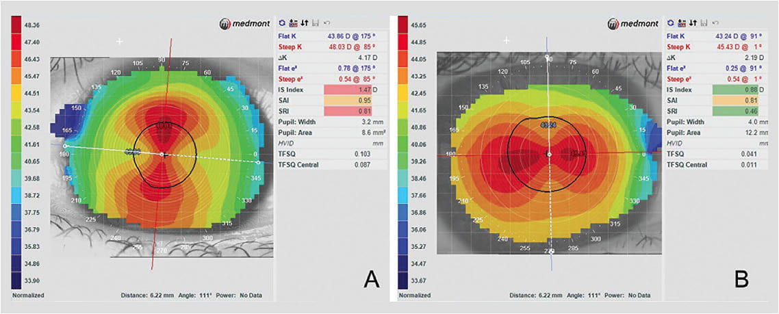 Figure 1. Regular corneal astigmatism. With-the-rule corneal astigmatism (A). Against-the-rule corneal astigmatism (B).