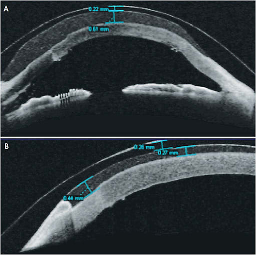 Figure 4. OCT images of large-diameter scleral lenses over ~40-year-old grafts OD/OS secondary to keratoconus. (A) Right eye: ~600µm clearance with 220µm center thickness. (B) Left eye: ~250µm to 270µm center clearance with 260µm center thickness.
Images courtesy of Karen G. Carrasquillo, OD, PhD