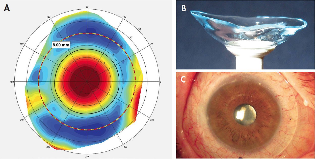 Figure 3. (A) Corneoscleral topography of an eye with GVHD and post-glaucoma surgery showing an asymmetric-irregular scleral profile. (B) A custom scleral lens designed with software that the system uses. (C) View of the scleral lens applied on the eye.