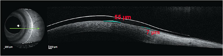 Figure 2. In an ideal hybrid lens fit, pockets of clearance between the back of a lens and the cornea (i.e., at the junction), in addition to lens movement with each blink, allow NaFl to seep under the lens and dilute the tear layer present.