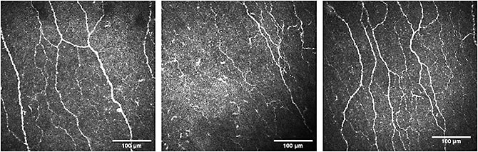 Figure 1. Representative images of the central corneal sub-basal nerve plexus in patients treated with neurotoxic chemotherapy: oxaliplatin (left, 62 years old), paclitaxel (center, 64 years old), and healthy control (right, 62 years old).