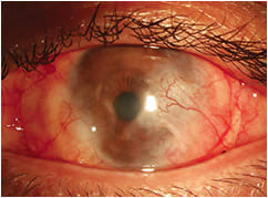 Figure 2. Patient who has limbal stem cell deficiency and scleritis due to an unknown underlying autoimmune disease.