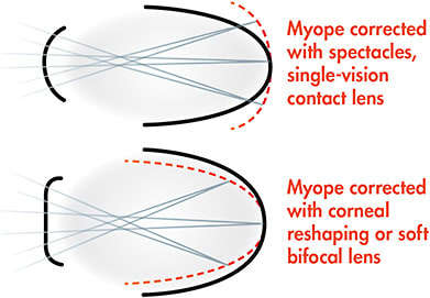 Figure 1. The top image demonstrates peripheral hyperopic defocus, which encourages eye growth and myopia. The bottom image shows peripheral myopic defocus, which discourages eye growth and myopia.
Image courtesy of Dr. Jeffrey Walline of The Ohio State University.