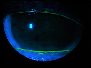 Figure 4. The cornea was completed healed after treatment.